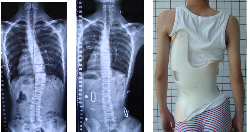 3连片.jpg 德国GBW侧弯支具-重庆工作室病例 GBW脊柱侧弯支具矫正案例