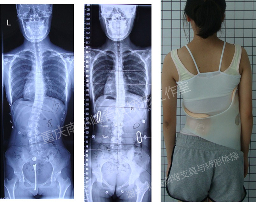 initpintu_wc.jpg 德国GBW侧弯支具-重庆工作室病例(三） GBW脊柱侧弯支具矫正案例