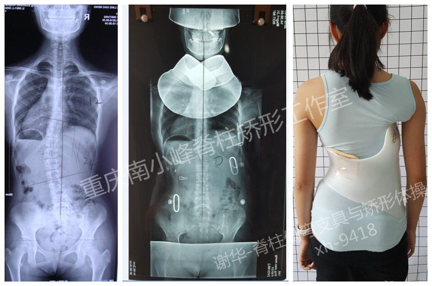 initpintu_凌XX.jpg 德国GBW侧弯支具-重庆工作室病例（四） GBW脊柱侧弯支具矫正案例