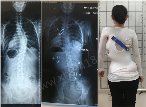 initpintu_副本9.jpg 德国GBW侧弯支具病例20170225北京 GBW脊柱侧弯支具矫正案例