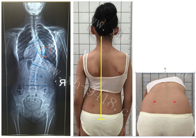 Cobb角50度使用德国GBW支具矫形病例 GBW脊柱侧弯支具矫正案例 第1张