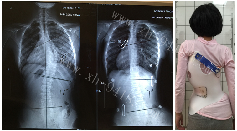 Cobb角50度使用德国GBW支具矫形病例 GBW脊柱侧弯支具矫正案例 第3张