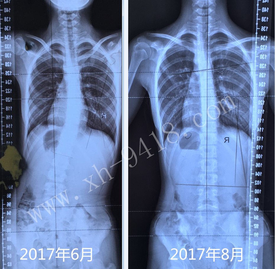 施罗斯体操练习两月，体表恢复对称的病例报道 矫形体操相关文章 第1张