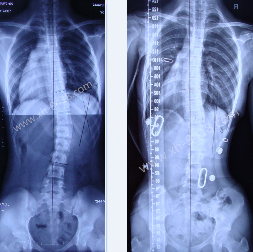 德国GBW侧弯支具病例20171005重庆 GBW脊柱侧弯支具矫正案例 第1张