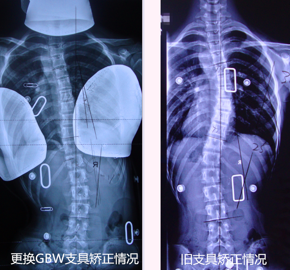 传统支具与德国GBW支具对比病例20171008重庆 GBW脊柱侧弯支具矫正案例 第1张