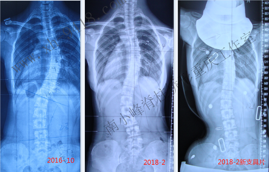GBW支具矫形病例20180304 GBW脊柱侧弯支具矫正案例 第1张