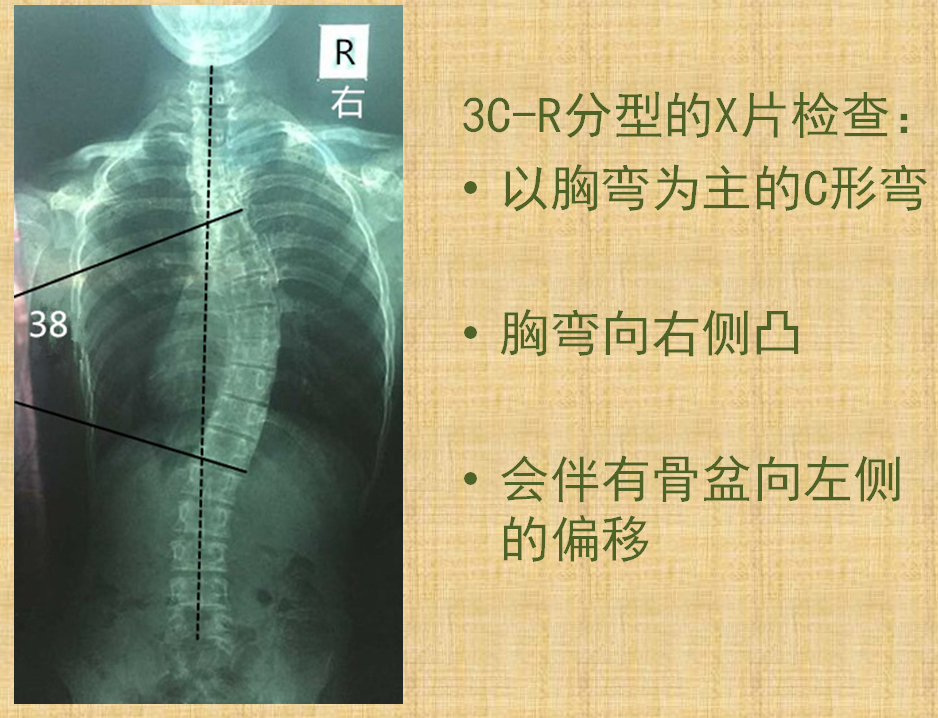 施罗斯脊柱侧弯矫形体操常见分型之3CR 矫形体操相关文章 第1张