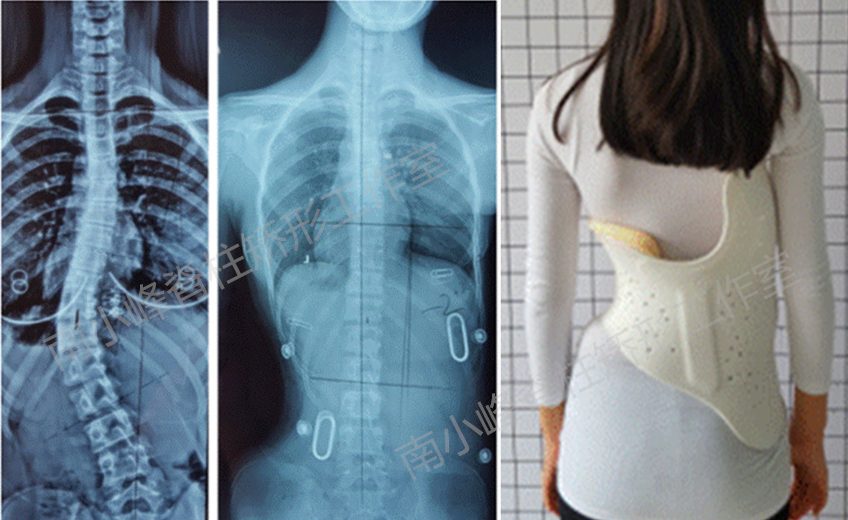 传统材料制作的支具和3D打印支具的对比及穿戴舒适性的影响 侧弯支具相关文章 第2张