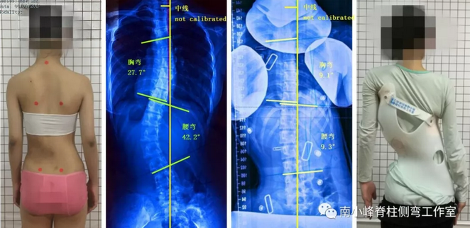 GBW侧弯支具——与南老师在杭州工作室制作支具实例 GBW脊柱侧弯支具矫正案例 第3张