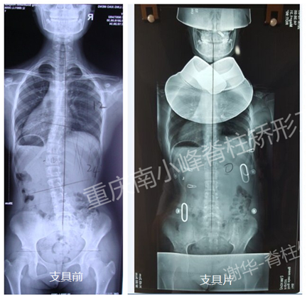 支具治疗青少年特发性脊柱侧弯的效果—早发现和早治疗的重要性 侧弯支具相关文章 第1张