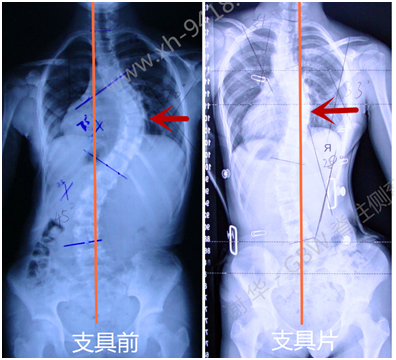 支具治疗青少年特发性脊柱侧弯的效果—早发现和早治疗的重要性 侧弯支具相关文章 第2张