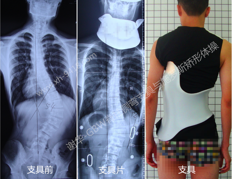 成年侧弯矫正案例 矫形体操相关文章 第3张