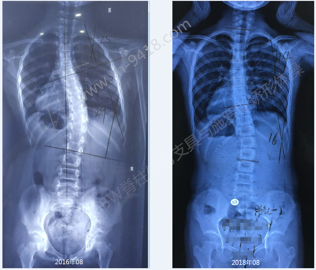 GBW支具矫正案例20180819 GBW脊柱侧弯支具矫正案例 第1张