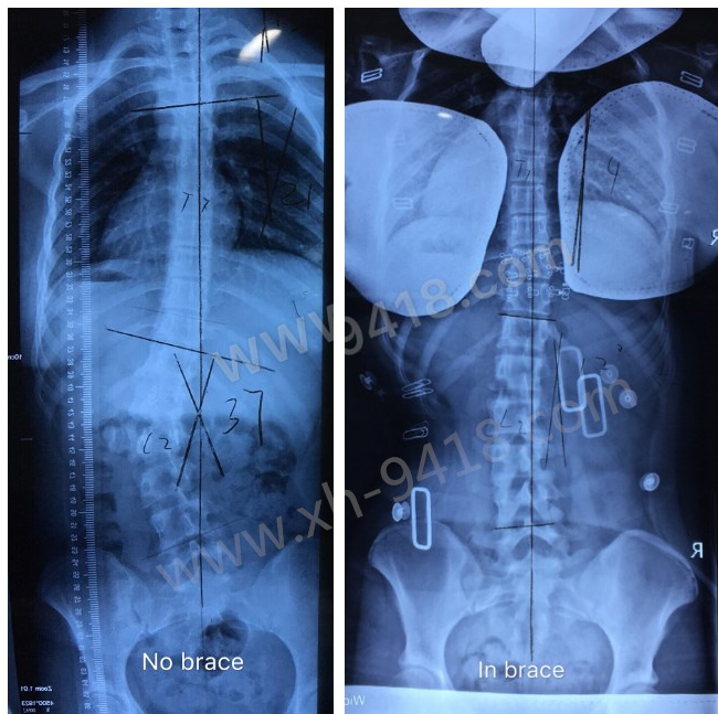 GBW支具矫正案例20180821 GBW脊柱侧弯支具矫正案例 第1张