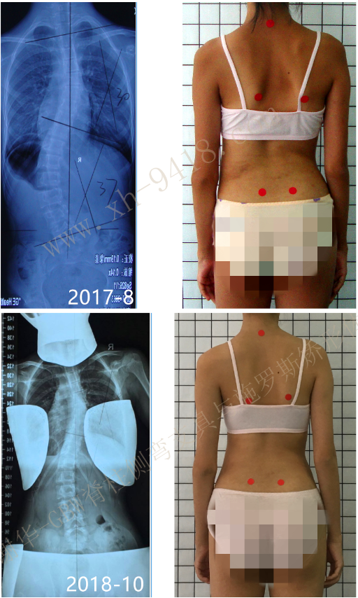 GBW支具矫正案例201811-1 GBW脊柱侧弯支具矫正案例 第1张