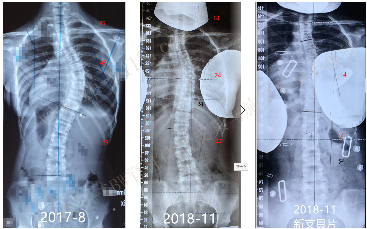 德国GBW侧弯支具案例201811-2 GBW脊柱侧弯支具矫正案例 第1张