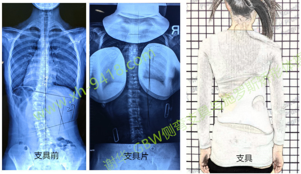 德国GBW侧弯支具案例20181223 GBW脊柱侧弯支具矫正案例 第1张