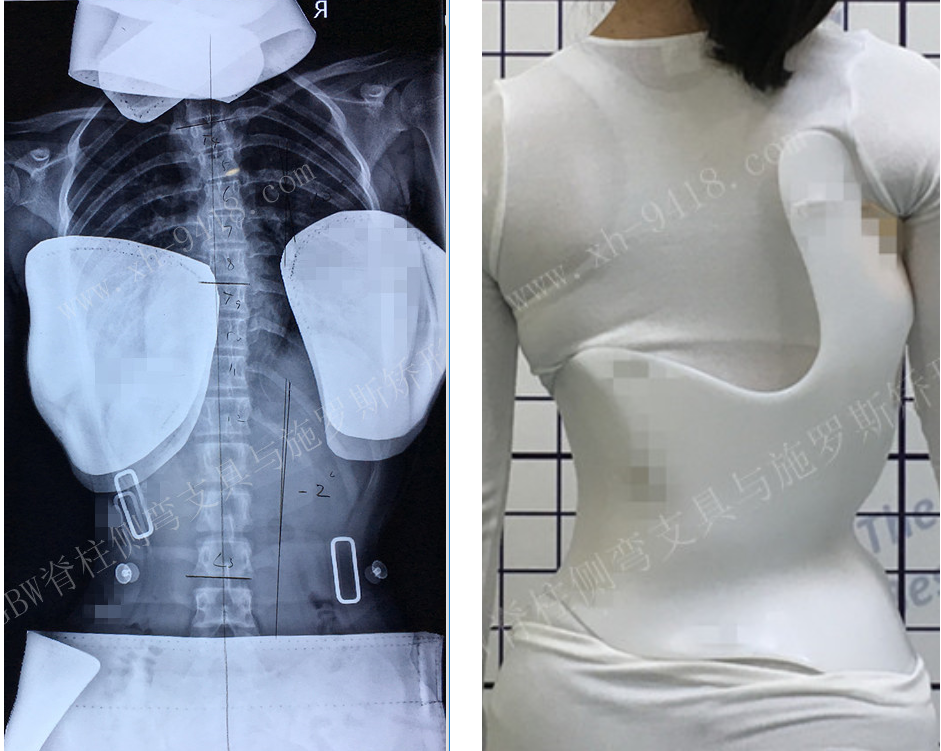GBW支具矫正案例20190304   GBW脊柱侧弯支具矫正案例 第3张