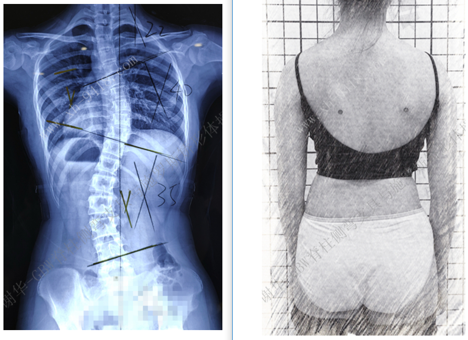GBW支具矫正案例20190316 GBW脊柱侧弯支具矫正案例 第1张