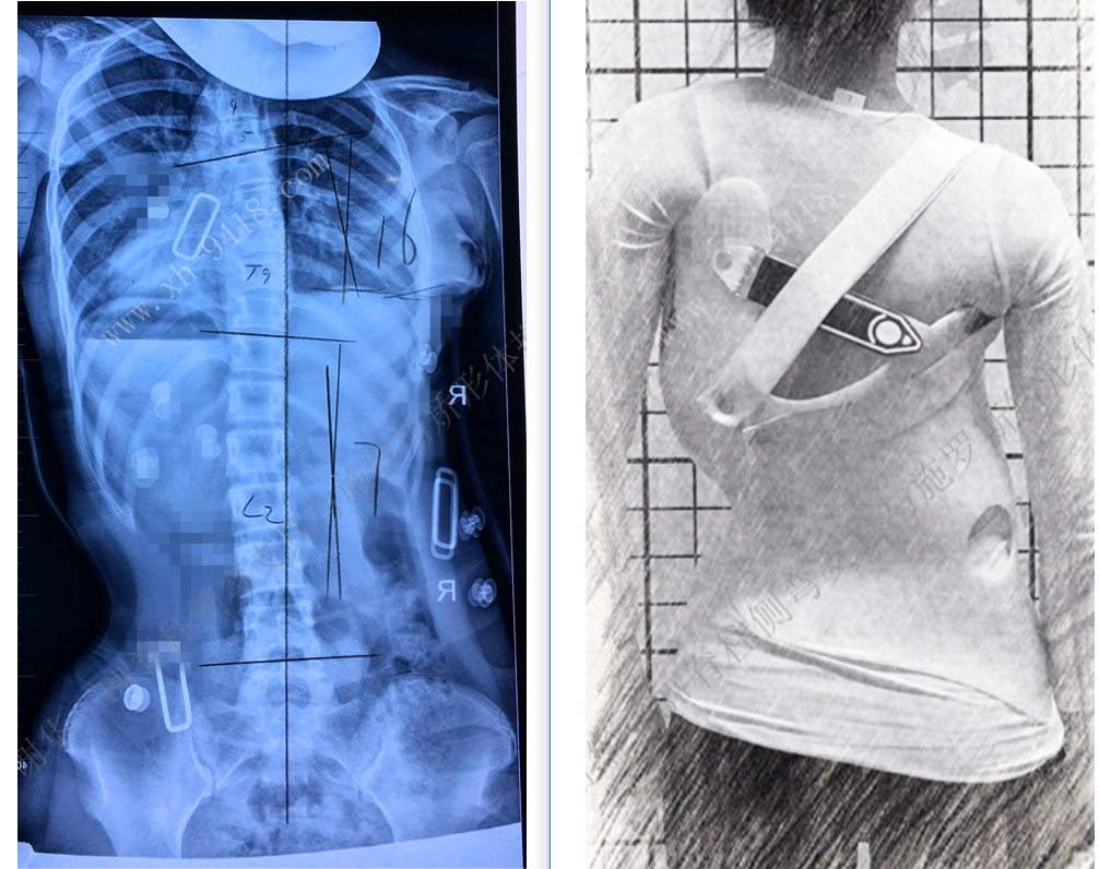GBW支具矫正案例20190316 GBW脊柱侧弯支具矫正案例 第2张