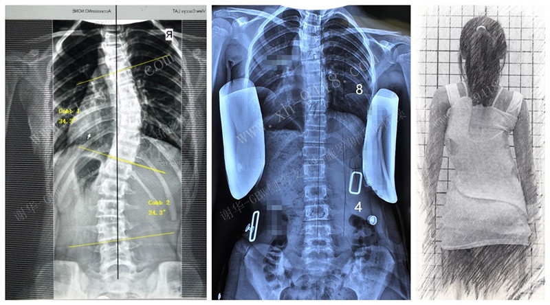 支具案例20190604 GBW脊柱侧弯支具矫正案例 第1张