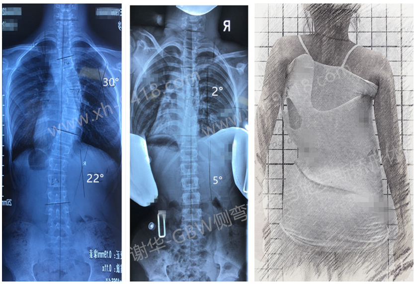 GBW支具矫正案例20190613 GBW脊柱侧弯支具矫正案例 第1张