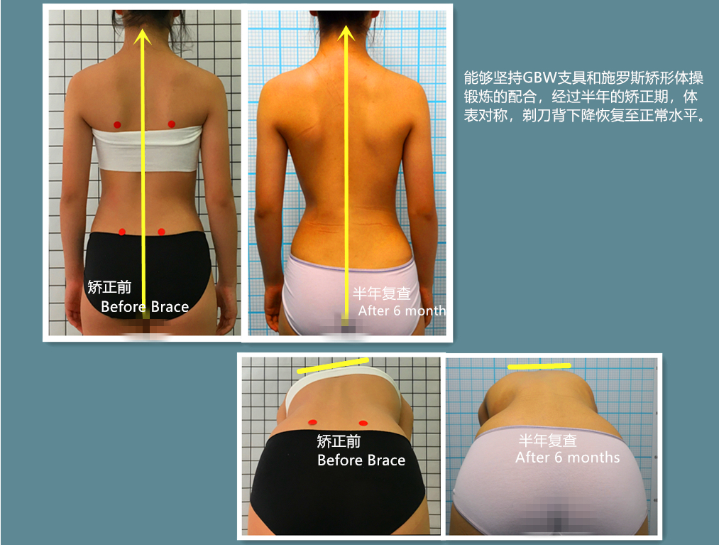GBW支具矫正案例20190714 GBW脊柱侧弯支具矫正案例 第2张