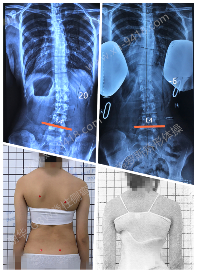 GBW支具矫正案例20190818 GBW脊柱侧弯支具矫正案例 第1张