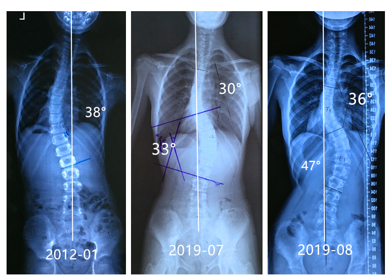 不良矫正导致侧弯加重案例20190823 侧弯支具相关文章 第1张