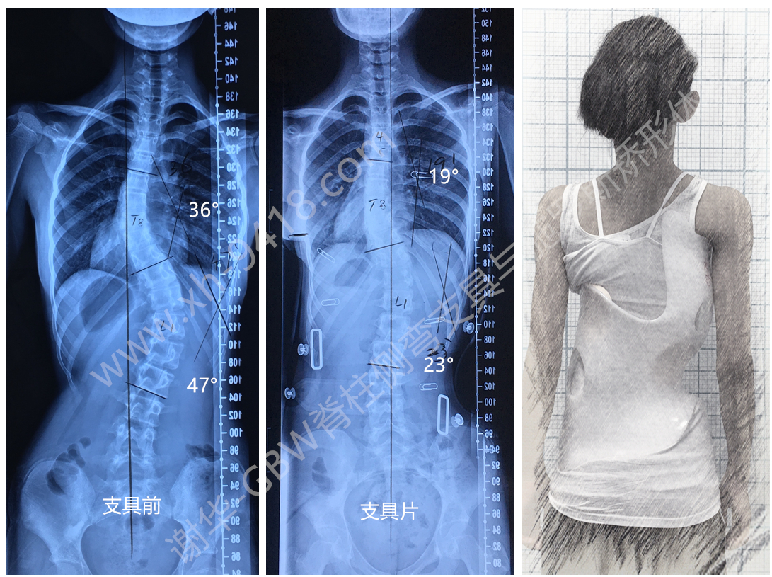 不良矫正导致侧弯加重案例20190823 侧弯支具相关文章 第3张