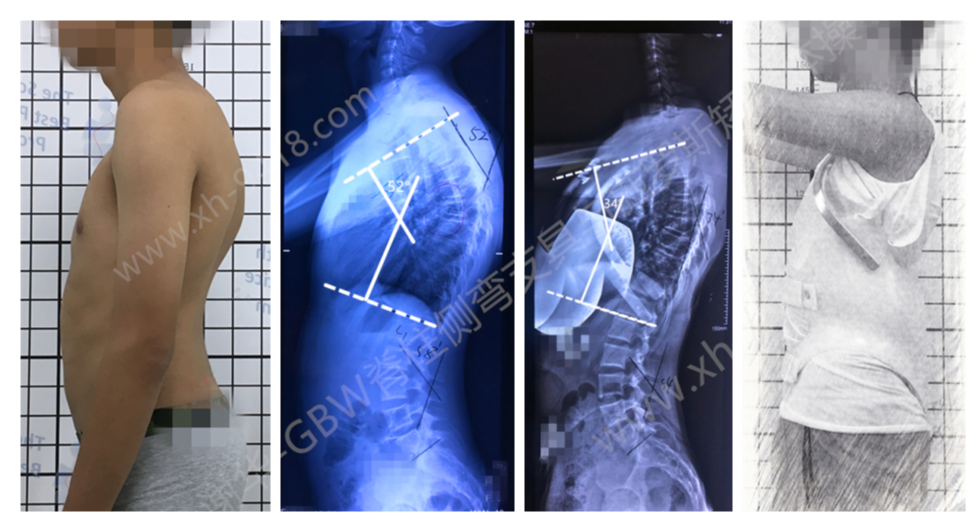 image.png 驼背支具-休门氏症(Scheuermann's disease)的支具矫正案例 GBW脊柱侧弯支具矫正案例