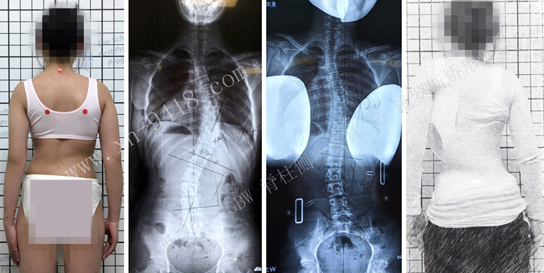 20190928GBW支具复查案例 GBW脊柱侧弯支具矫正案例 第1张