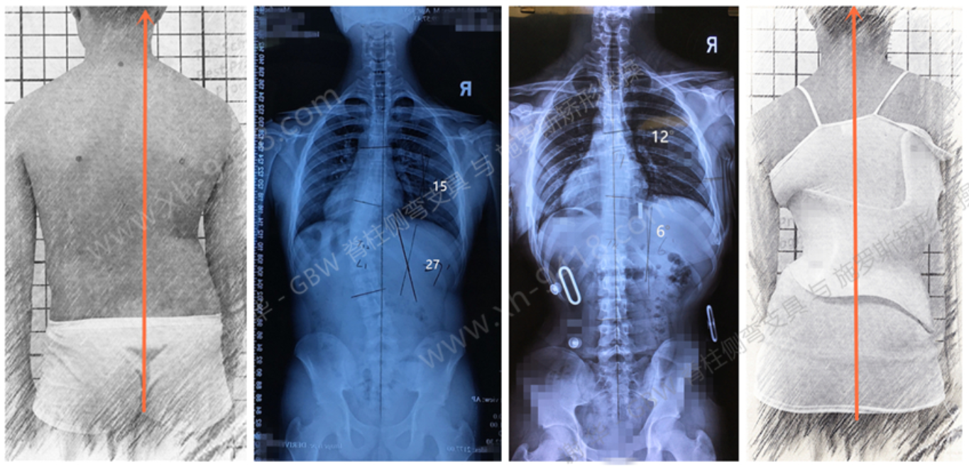  GBW施罗斯支具矫正案例20191204 GBW脊柱侧弯支具矫正案例 第1张