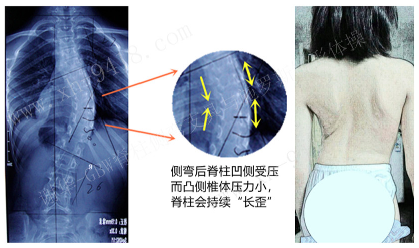 脊柱生长对侧弯矫正的影响 侧弯支具相关文章 第1张