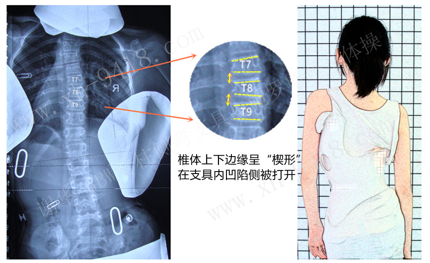 脊柱生长对侧弯矫正的影响 侧弯支具相关文章 第2张