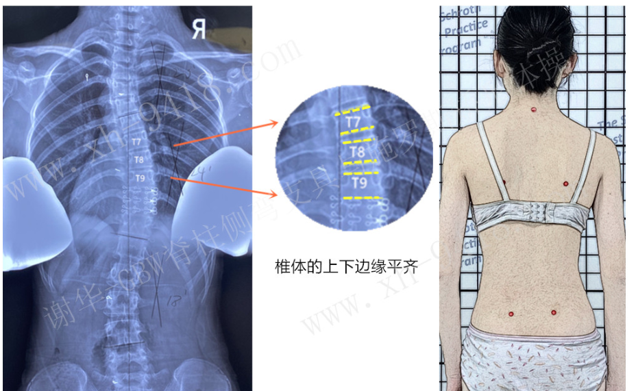 脊柱生长对侧弯矫正的影响 侧弯支具相关文章 第3张