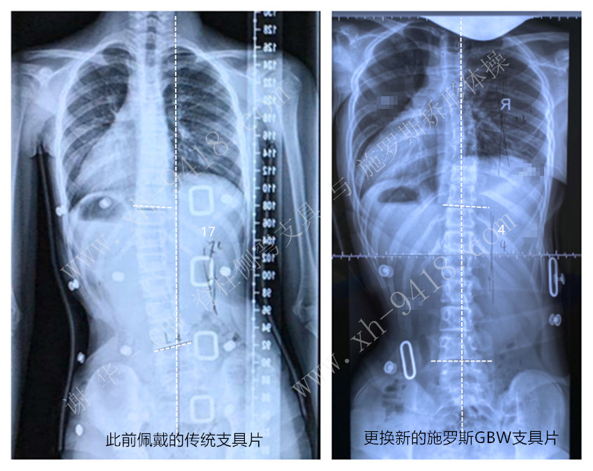 施罗斯GBW支具矫正案例20200523 GBW脊柱侧弯支具矫正案例 第1张