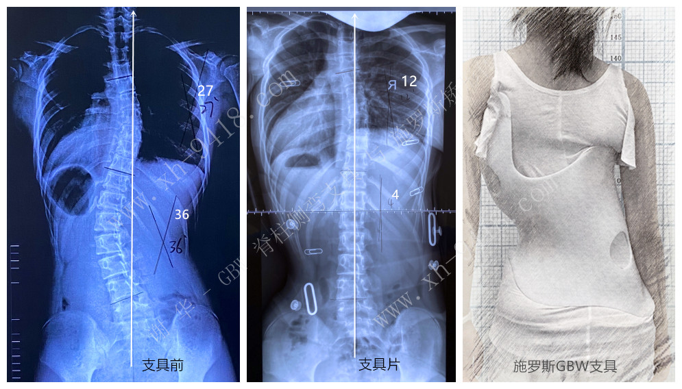 施罗斯GBW支具矫正案例20200523 GBW脊柱侧弯支具矫正案例 第2张