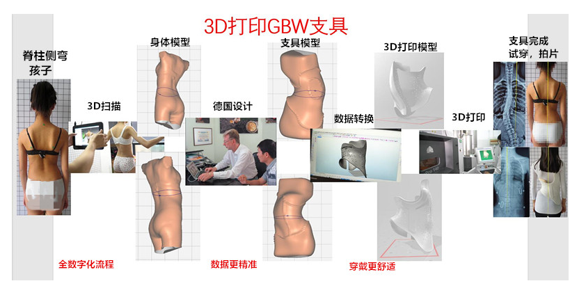 3D打印版GBW施罗斯支具接受定制 侧弯支具相关文章 第2张