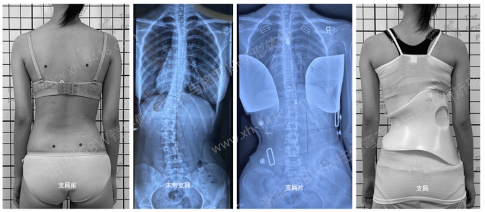 GBW支具矫形案例20200828 GBW脊柱侧弯支具矫正案例 第1张