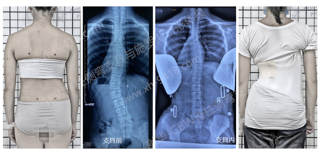 GBW支具矫形案例20201118 GBW脊柱侧弯支具矫正案例 第1张