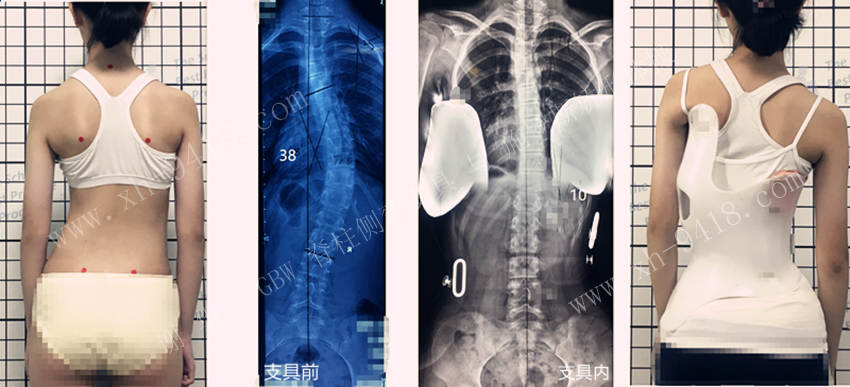 GBW支具案例20210130+后期随访 GBW脊柱侧弯支具矫正案例 第1张