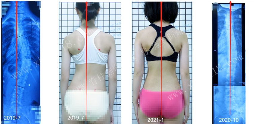GBW支具案例20210130+后期随访 GBW脊柱侧弯支具矫正案例 第2张