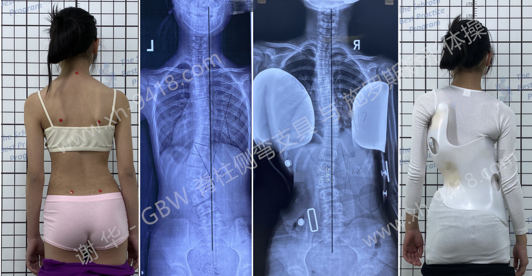 GBW支具案例20210419 GBW脊柱侧弯支具矫正案例 第1张
