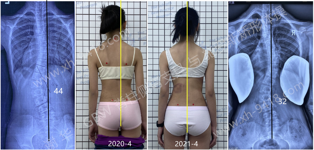 GBW支具案例20210419 GBW脊柱侧弯支具矫正案例 第2张