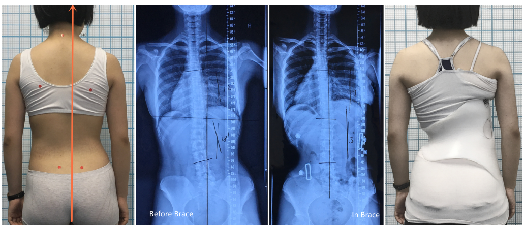 GBW 支具矫正连续随访案例20210427   GBW脊柱侧弯支具矫正案例 第1张