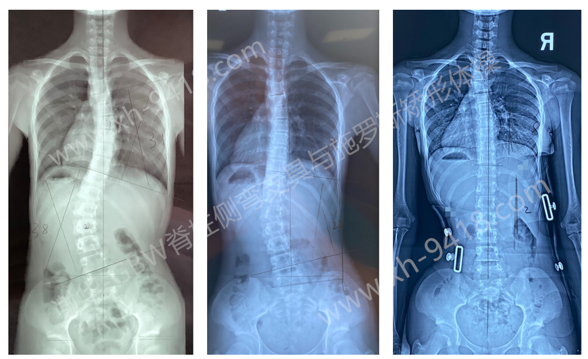 GBW支具持续矫正案例20210903 GBW脊柱侧弯支具矫正案例 第1张