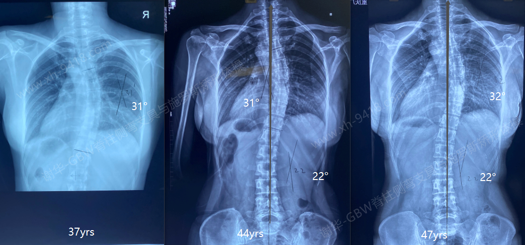 一例成年侧弯的长期变化——稳定的侧弯 侧弯支具相关文章 第1张