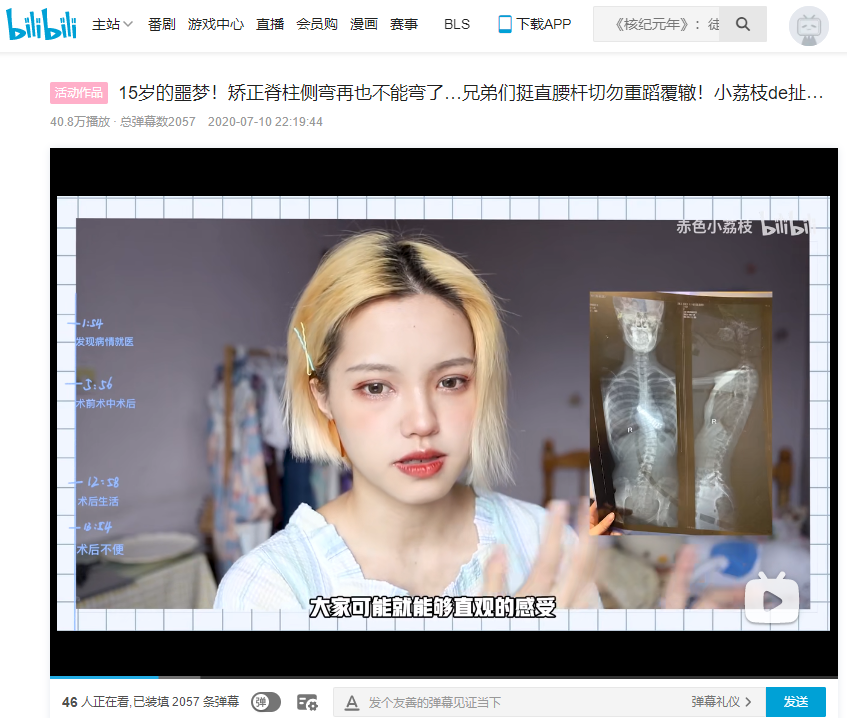 15岁的噩梦！矫正脊柱侧弯再也不能弯了 侧弯支具相关文章 第1张