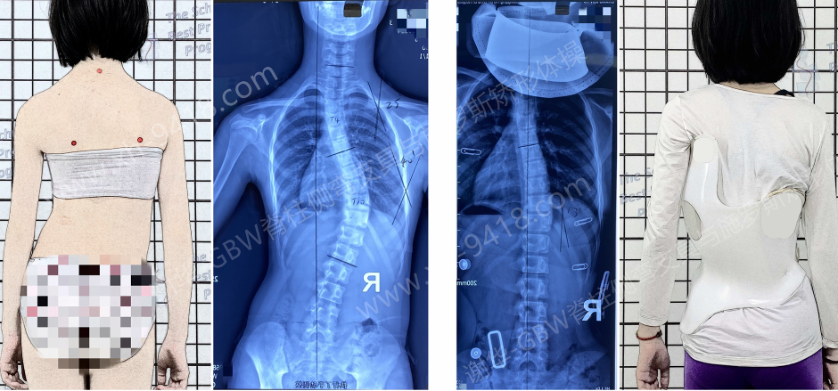 GBW支具矫正案例20220212——40度到16度1年的努力 GBW脊柱侧弯支具矫正案例 第1张